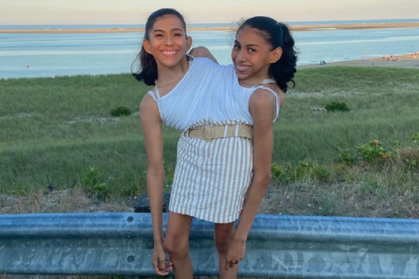 Сиамские сестры-близнецы Кармен и Лупита признались, что у одной из них есть парень