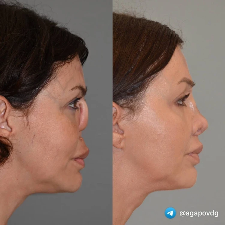 «Я хотела вернуть утраченную красоту»: Алиса Казьмина впервые показала лицо после финальной операции на нос